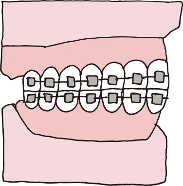 ワイヤーブラケット矯正