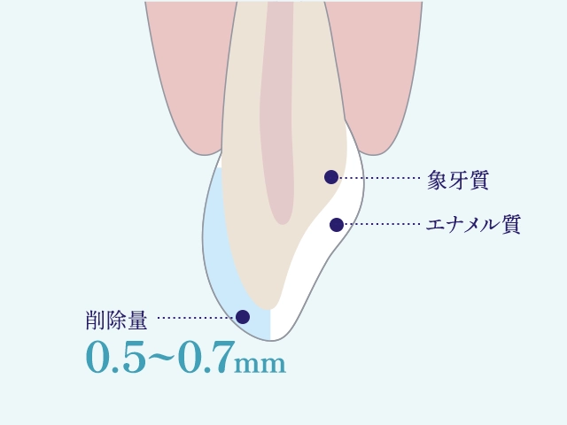ラミネート