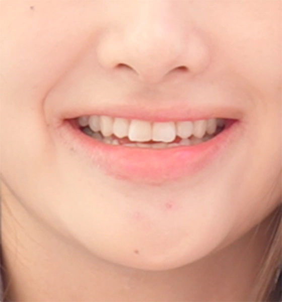 ビフォー